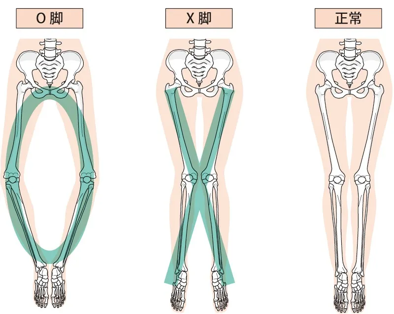 O脚・X脚は矯正できるか——骨格・筋膜・足底アーチの連鎖を整体師が本気解説